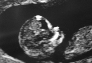 Scotland's 12-week ultrasound.